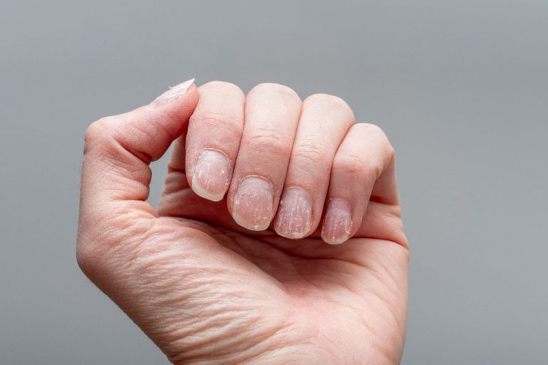 Une personne montrant ses doigts qui grattent après une pose de vernis semi-permanent