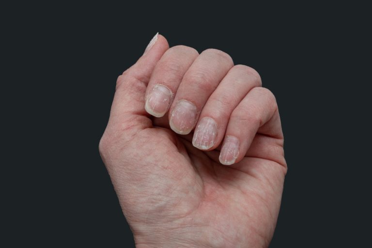 Une personne montrant ses ongles arrachés par des faux ongles
