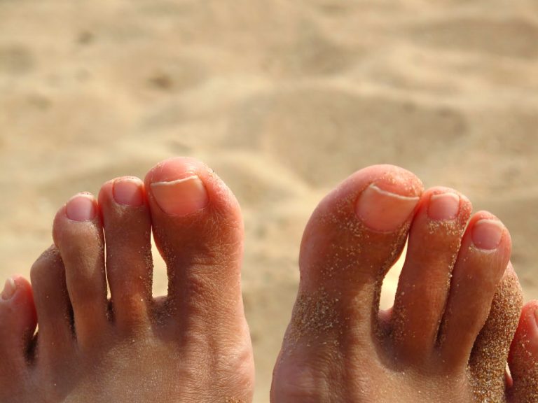 Pieds d'une personne avec des ongles qui poussent vers le haut