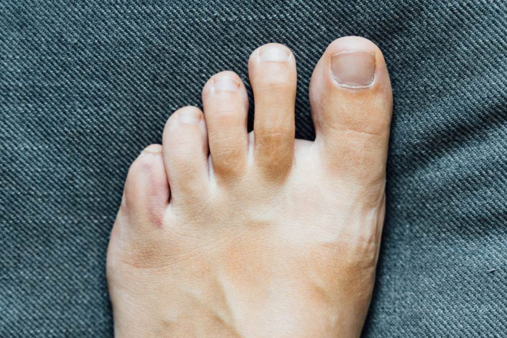 Un pieds avec des ongles poussés vers le haut
