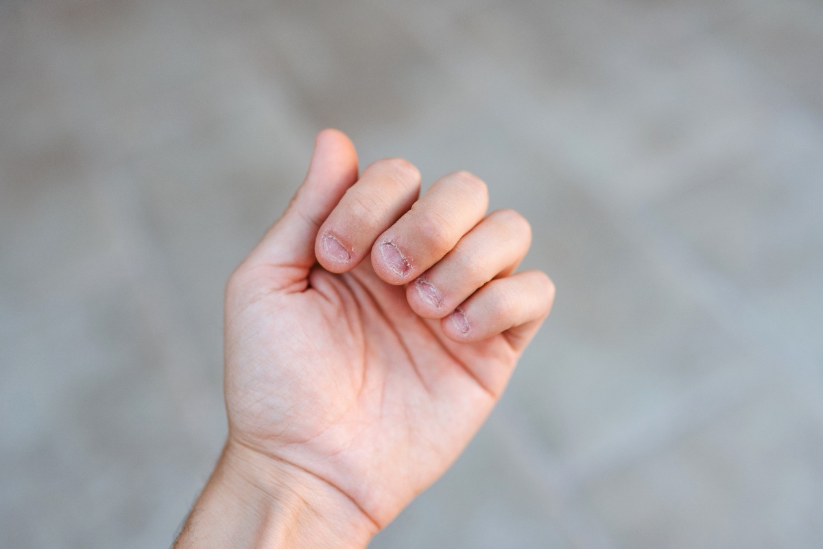 Main d'une personne avec des ongles rongés