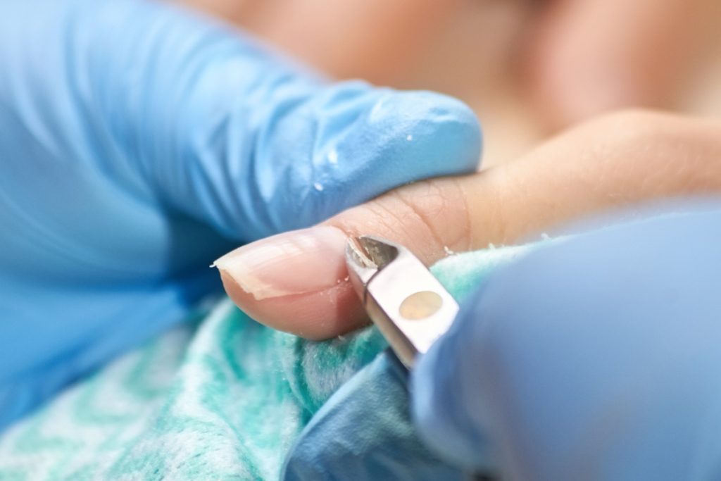Une personne qui porte un gant et soigne une infiltration sous ongle