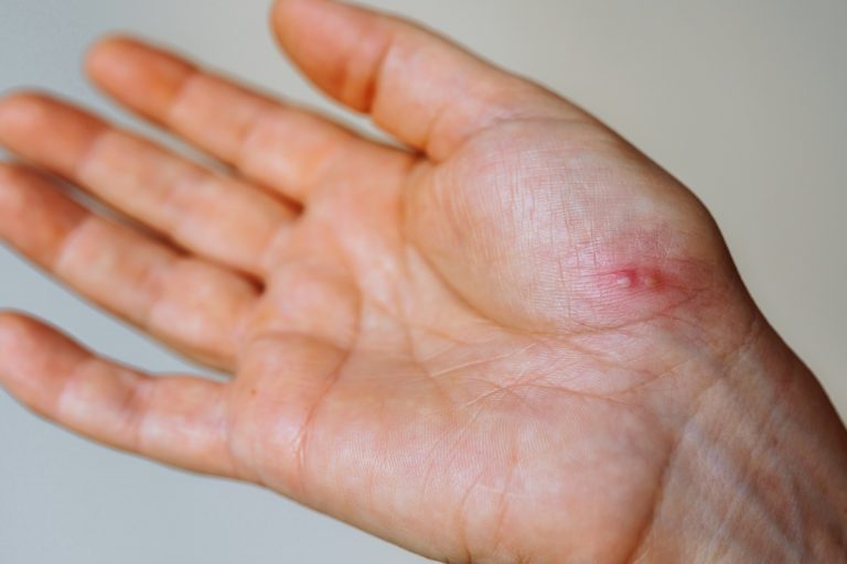 Une écharde enfoncée dans la main d'une personne