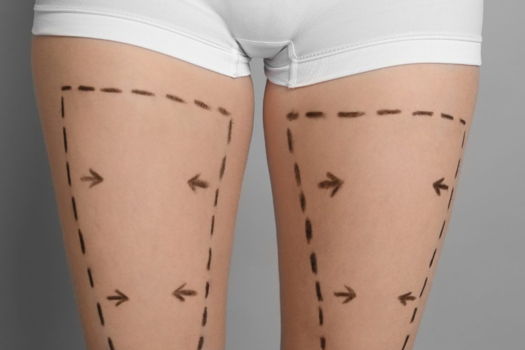 Cuisses avec marques de chirurgie esthétique